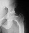 X linked hypophosphatemic Vit D resistant osteomalacia with pseudofracture 25F