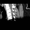 Tube failure 46M