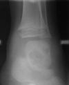 Coccidoidomycosis talus 3M