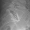 L5-S1 zero profile ALIF with Orion SeaSpine cage made of NanoMetalene