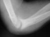 Gout medial epicondyle 60M