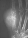 Chondrosarcoma metacarpal 52F