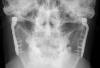 TMJ arthroplasty