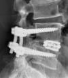 TLIF Depuy synthes instrumentation Globus cage