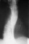 15M Neurofibromatosis scoliosis