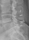 Radiolucent interspinous spacers 55F
