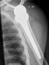 Reverse Total ShouulderArthroplasty