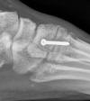 Lisfranc screw