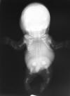 Achondrogenesis II Saldino Nooman