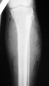 Gas gangrene 29M
