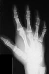 Brachydactyly type C 3