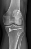 ACL repair 64M