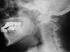 Ossified stylohyoid ligament 60M
