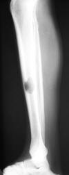 Mets to tibia