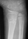 Post traumatic osteolysis distal ulna