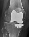 ConforMIS Custom iDuo knee combined medial compartment arthroplasty and patellofemoral arthroplasty