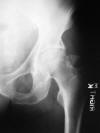 Pathologic avulsion greater trochanter 56M