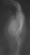 Neurofibromatosis, spine and hand