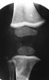 Lead poisoning ped knee
