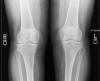 Tibial tug lesions 83F