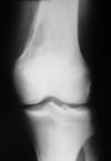 Osteogenic sarcoma distal femur small cell
