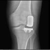 Lateral unicompartmental knee arthoplasty Zimmer Persona