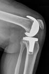 DePuy PFC Sigma TKA