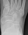 Cuboid pseudocyst 37F