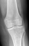 Patelectomy and prior Fulkerson osteotom