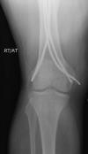 Enders nail 45M