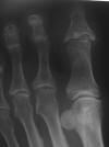 58M charcot foot, neuropathic