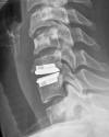 Anterior right-sided microforaminotomy at C5