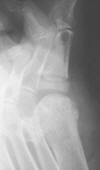 Silastic 1st toe proximal phalangeal base arthroplasty