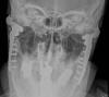 TMJ Prosthesis