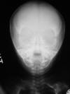 COngenital syphilis 1mF